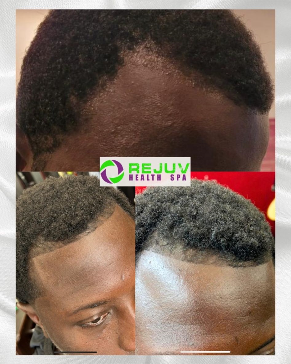 Hair restoration